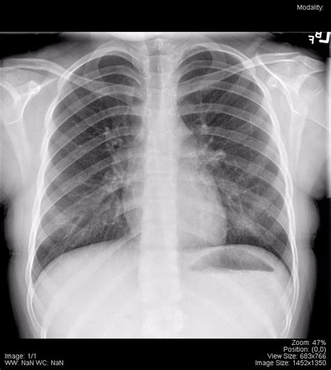 Chest – Undergraduate Diagnostic Imaging Fundamentals