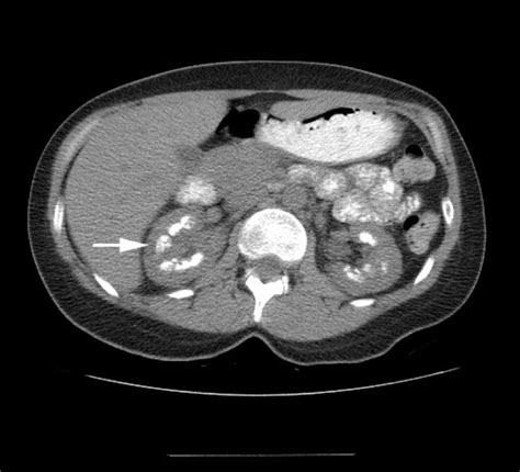 Image Diagnosis: Medullary Sponge Kidney | The Permanente Journal