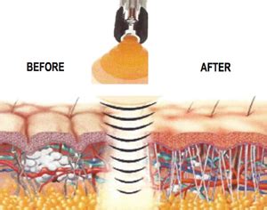 Acoustic Wave Therapy Las Vegas NV | A Touch Above Chiropractic