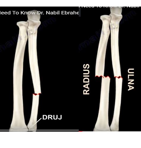 Radius and Ulna shaft fractures — OrthopaedicPrinciples.com