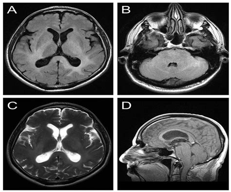 Cureus | An Indolent Presentation of Gliomatosis Cerebri in an Elderly ...