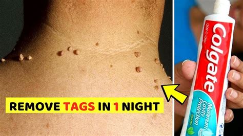 Remove Skin Tag in 1 Night from Your Neck, Eyelids or Face – World’s ...