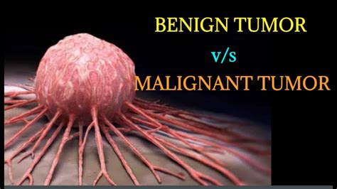 Differences between BENIGN and MALIGNANT Tumor - YouTube