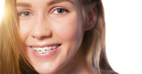 How Braces Help Get a Perfect Smile : Academy Dental: Cosmetic Dentists