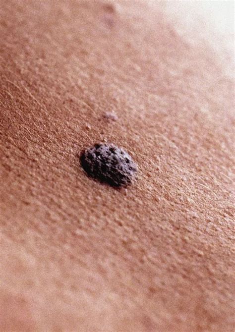 What's the difference between a freckle and mole and how do you tell if they need medical ...