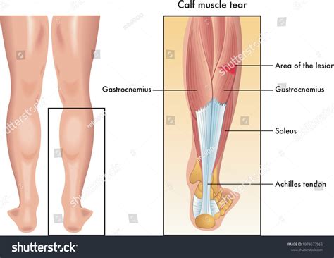 Medical Illustration Symptoms Calf Muscle Tear Stock Vector (Royalty Free) 1973677565 | Shutterstock