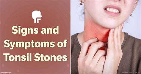 Signs and Symptoms of Tonsil Stones