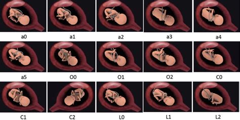 Model Figure of all types of nuchal cord. | Download Scientific Diagram