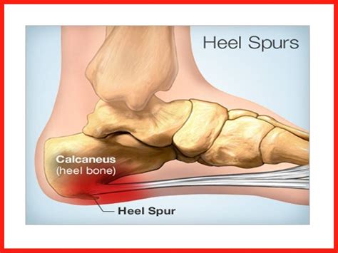 Pain in Heel of Foot | How to Get Rid of Foot Pain Caused by Heel Spurs or Pain in heel of foot ...