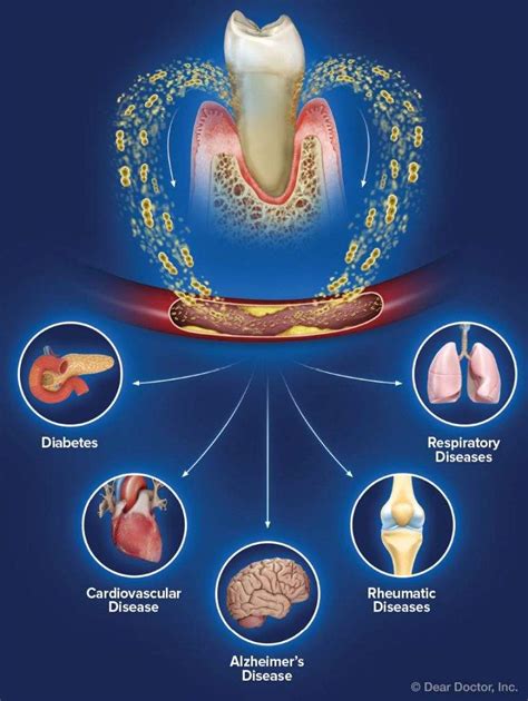 Gum Disease Treatment Wollongong - Figtree Family Dental