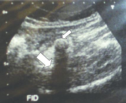 Ultrasonography of the patient, showing fecalith (smaller arrow) in the ...