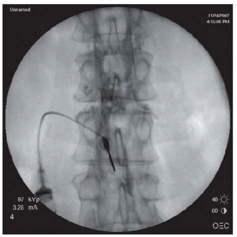 Spinal Injection Procedures | Musculoskeletal Key