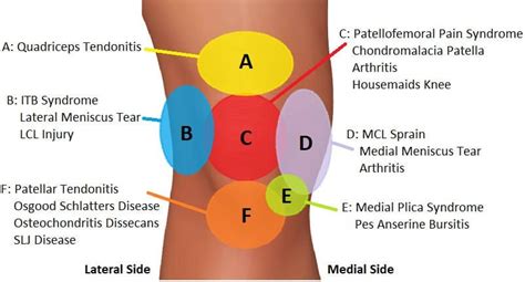 Knee pain: Our knee pain diagnosis chart helps you to work out what is ...