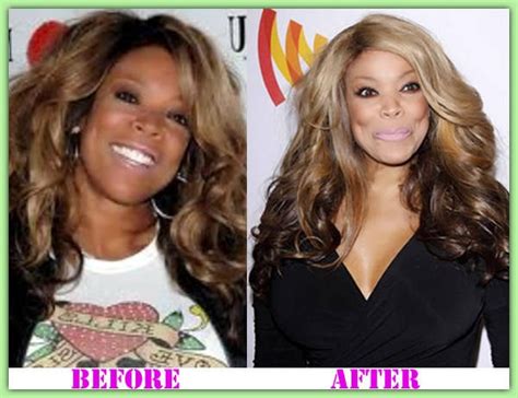 Plastic Surgery and Nose Job: Wendy Williams Plastic Surgery – Confirmed Surgeries