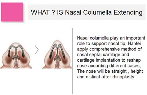 Rhinoplasty / Nasal Beauty / Nasal Columella Extending_Plastic Surgery ...