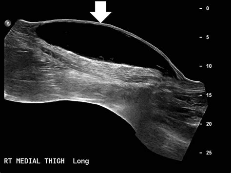 Morel-Lavallee Lesion Initially Diagnosed as Quadriceps Contusion: Ultrasound, MRI, and ...