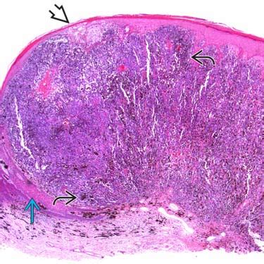 Nodular Melanoma Histology