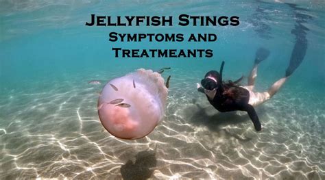 Jellyfish Stings – Symptoms, Treatment & Tips To Avoid Getting Stung