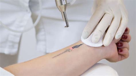 Tattoo Removal Aftercare – SCULPTDTLA.COM