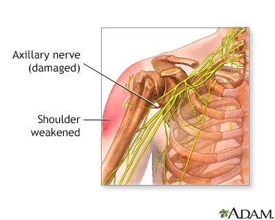 Axillary nerve dysfunction Information | Mount Sinai - New York