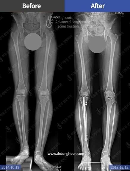 Leg Length Discrepancy – Limb Lengthening & Complex Reconstruction ...