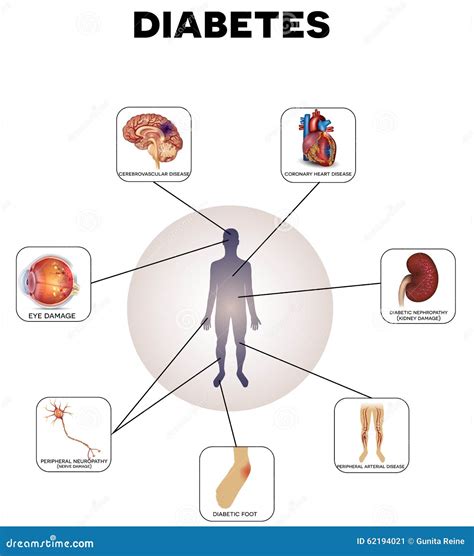 Diabetes Mellitus stock vector. Image of info, brain - 62194021