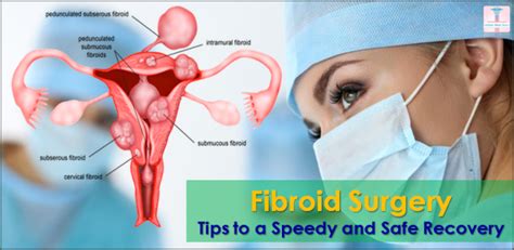 Fibroid Surgery: Tips to a Speedy and Safe Recovery