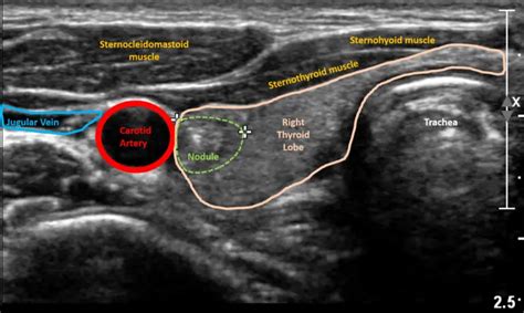 Thyroid Ultrasound: Purpose and Procedure | Healthtian