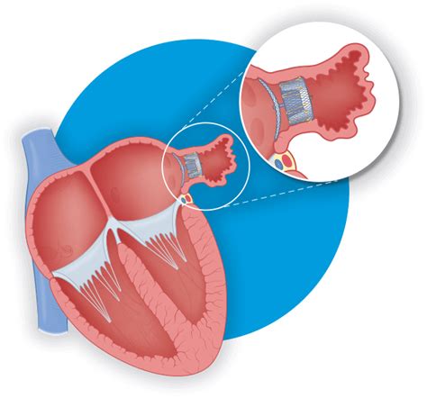 Abbott - AMPLATZER™ AMULET™ - Corpmedical