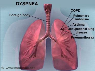 Dyspnea / Shortness of Breath