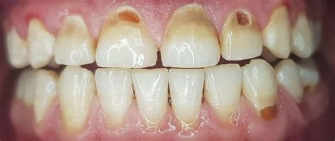 DENTAL EROSION: The Causes and Cures - The Dental Gazette