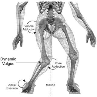 Common mechanism of ACL injury. Figure reproduced from Hewett, TE, et ...