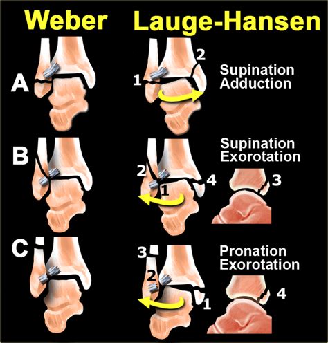 Ankle fracture - Weber and Lauge-Hansen Classification | Ankle fracture, Radiology imaging ...