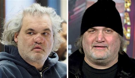 What Happened to Artie Lange's Nose?