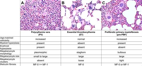 Clinicopathologic Spectrum Of Myeloid Neoplasms With, 46% OFF