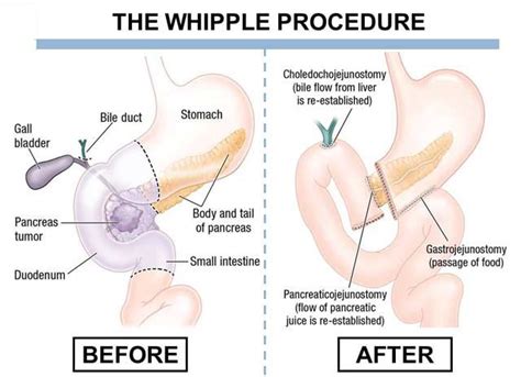 Whipple Procedure – South Florida Sugical Oncology