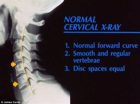 How To Read Cervical Spine X Rays - Dorothy Jame's Reading Worksheets