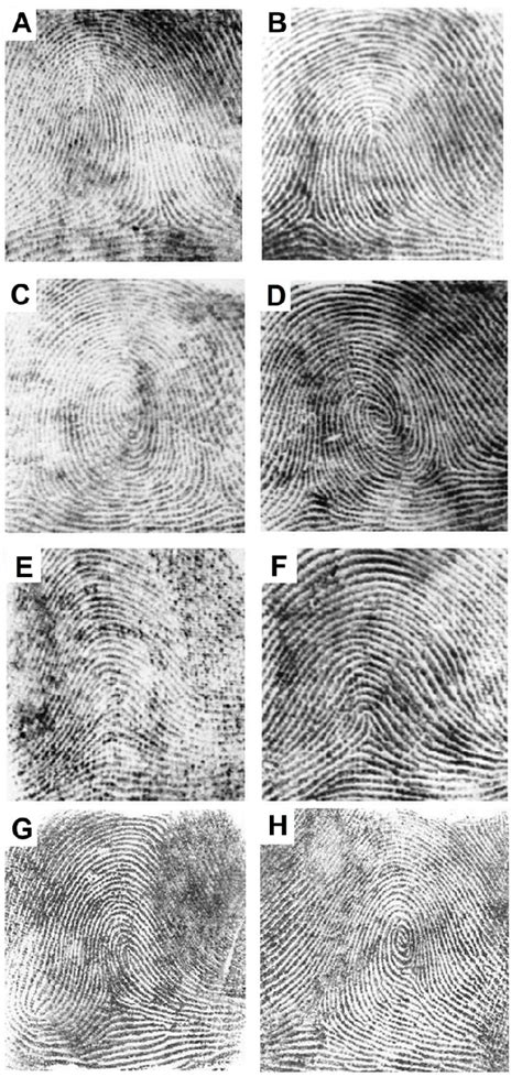 Different types of fingerprints. A: Ulnar loop, B: Radial loop, C:... | Download Scientific Diagram