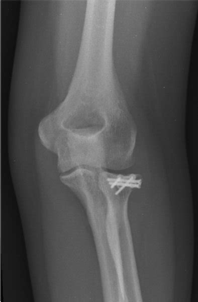 Radial Head Fracture Fixation | Arm Docs