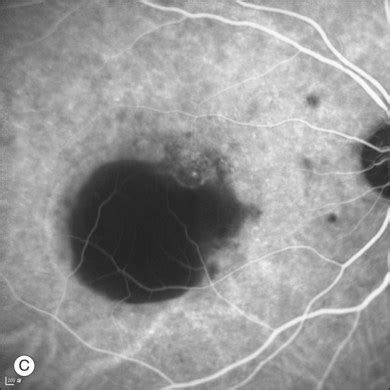 Central Serous Chorioretinopathy | Ento Key