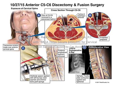 $450,000 for Cervical Fusion Surgery Caused by Car Accident ...