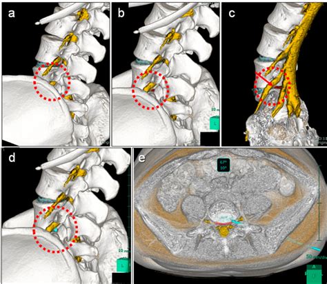 Simulation of full endoscopic lumbar discectomy with the transforaminal ...