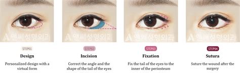 Lateral Canthoplasty in Korea | Answer Plastic Surgery