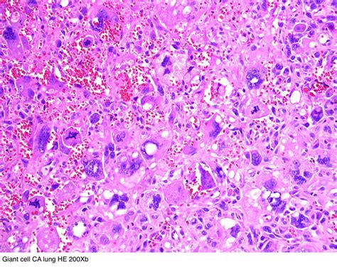 Pathology Outlines - Giant cell carcinoma