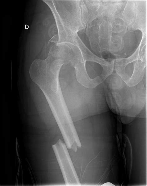 Fractura luxación de cadera asociada a fractura diafisaria de fémur. A propósito de un caso ...