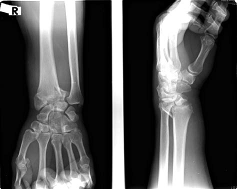 Radial Styloid Fracture