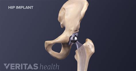 Advantages and Disadvantages of Anterior Hip Replacement