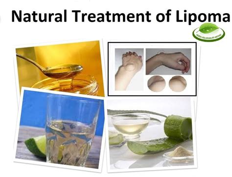 Best 25+ Lipoma treatment ideas on Pinterest | Lipoma removal, Lump ...