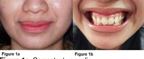 dueña dramático peso labial frenectomy before and after smile Tipo ...