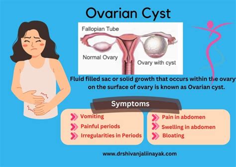 What is Ovarian Cyst and what are its symptoms and treatments? Dr ...